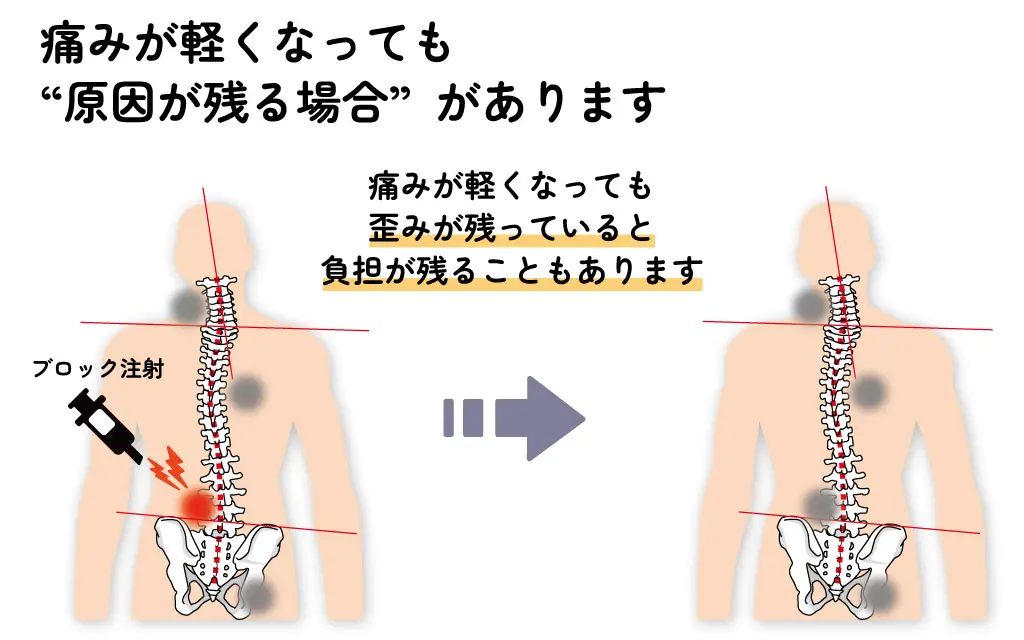 神経ブロック注射で痛みは軽くなるが、背骨の歪みなど原因が残る状態を示した図