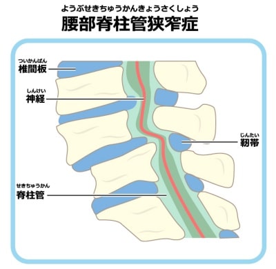 脊柱管狭窄症の図