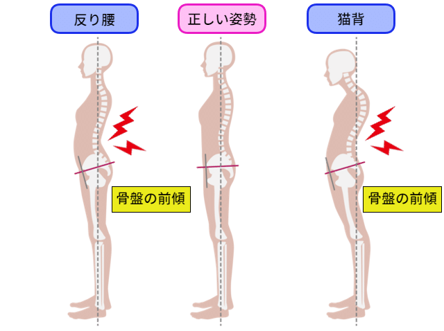 正しい姿勢と反り腰の骨格比較