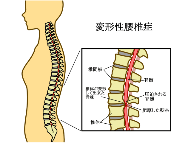 変形性腰椎症の解剖図