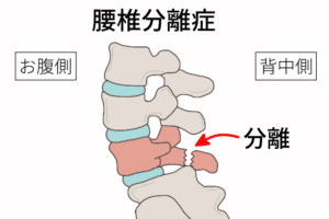 腰椎5番の分離症の図