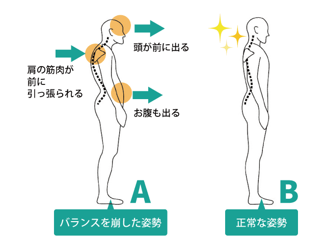 歪んだ姿勢と正常な姿勢の比較図