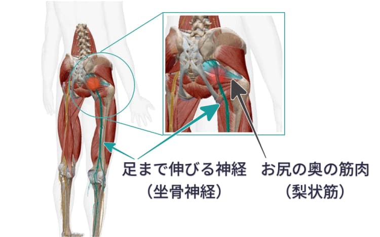 長岡市で多い坐骨神経痛の原因(梨状筋による神経圧迫)のイメージ図